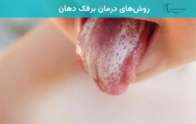 روشهای درمان برفک دهان