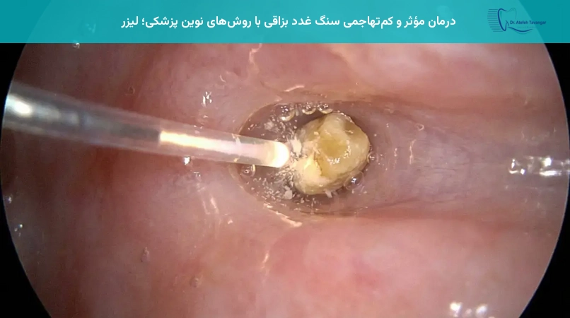 درمان مؤثر و کمتهاجمی سنگ غدد بزاقی با روشهای نوین پزشکی؛ لیزر