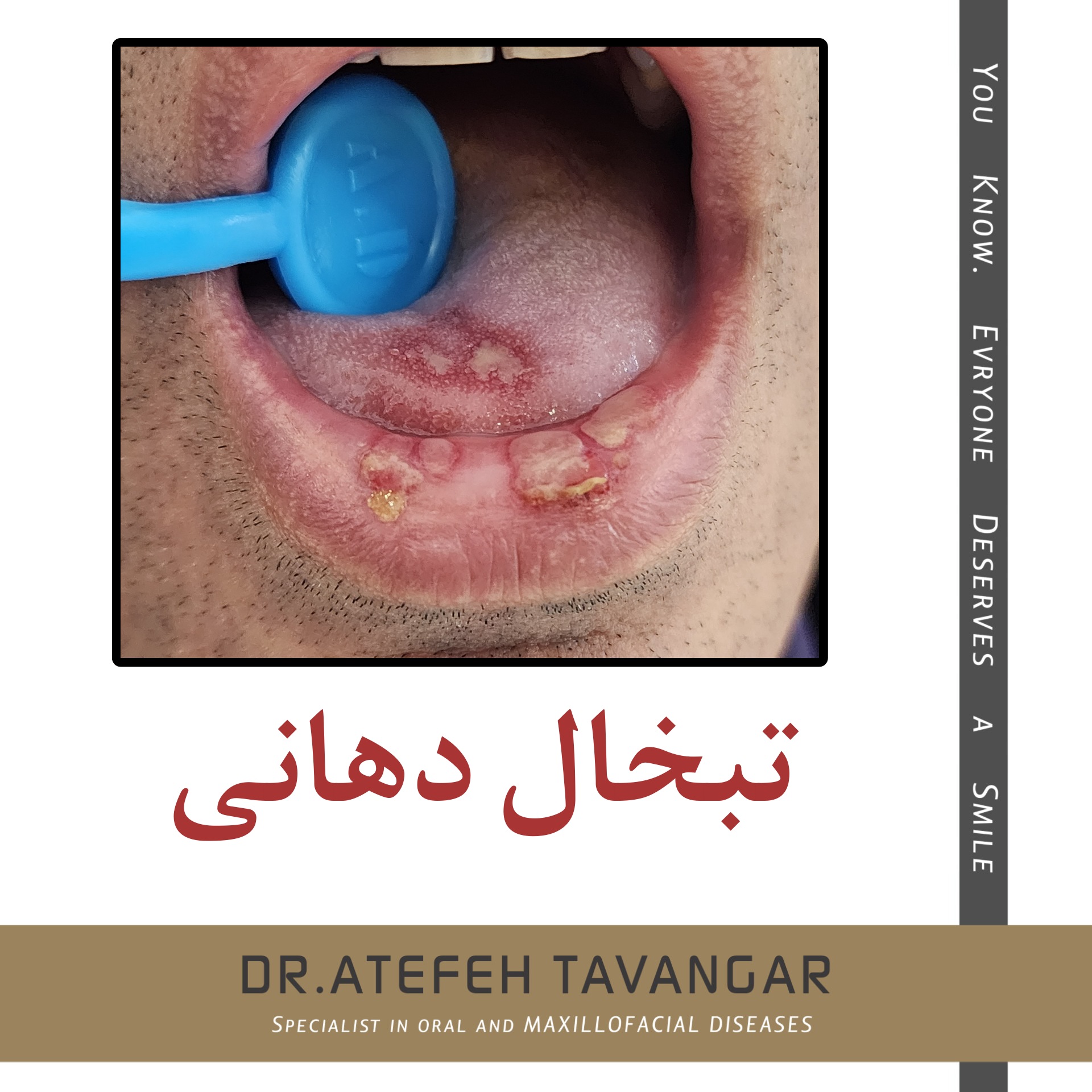 آیا آفت دهان نشانه ایدز است