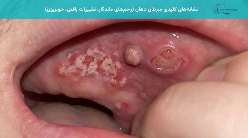 نشانههای کلیدی سرطان دهان (زخمهای ماندگار، تغییرات بافتی، خونریزی)