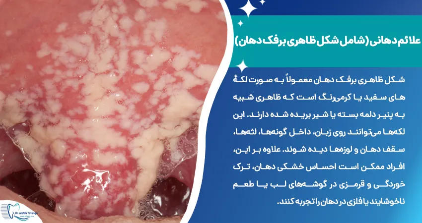 شکل ظاهری برفک دهان