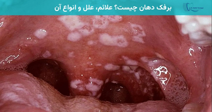 برفک دهان چیست؟ علائم، علل و انواع آن