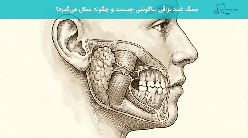 سنگ غدد بزاقی بناگوشی چیست و چگونه شکل میگیرد؟