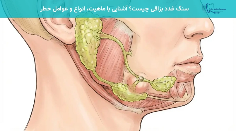 سنگ غدد بزاقی چیست؟ آشنایی با ماهیت، انواع و عوامل خطر