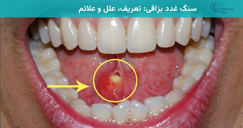 سنگ غدد بزاقی: تعریف، علل و علائم