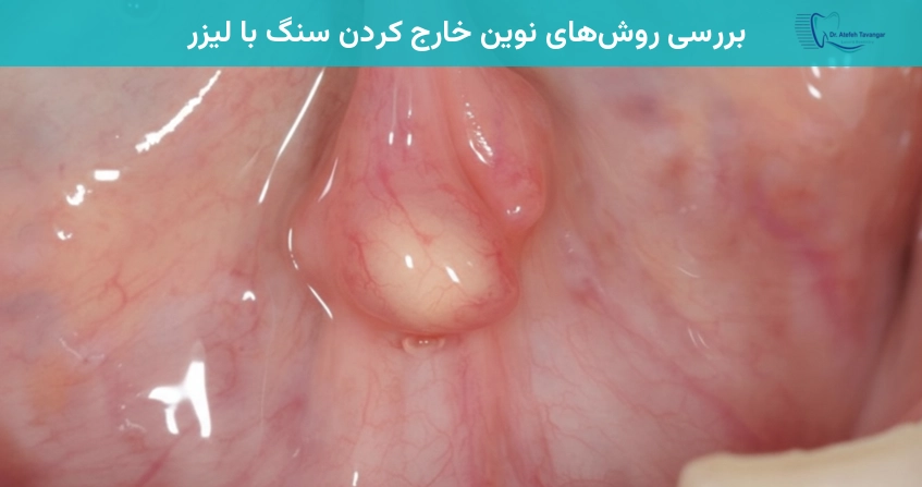 بررسی روش های نوین خارج کردن سنگ با لیزر