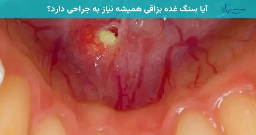 آیا سنگ غده بزاقی همیشه نیاز به جراحی دارد؟