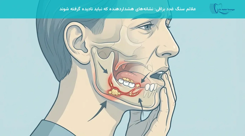 علائم سنگ غدد بزاقی: نشانههای هشداردهنده که نباید نادیده گرفته شوند