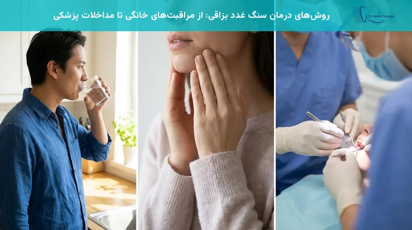 روشهای درمان سنگ غدد بزاقی: از مراقبتهای خانگی تا مداخلات پزشکی