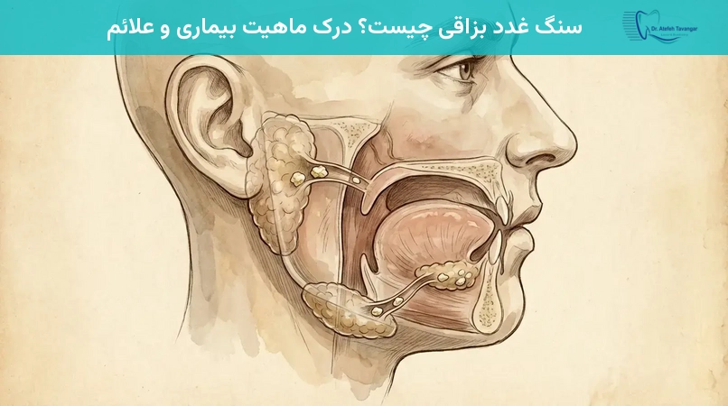سنگ غدد بزاقی چیست؟ درک ماهیت بیماری و علائم