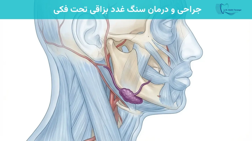 جراحی و درمان سنگ غدد بزاقی تحت فکی