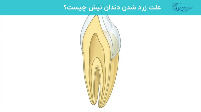 علت زرد شدن دندان نیش چیست؟
