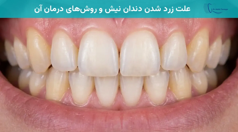 علت زرد شدن دندان نیش و روشهای درمان آن