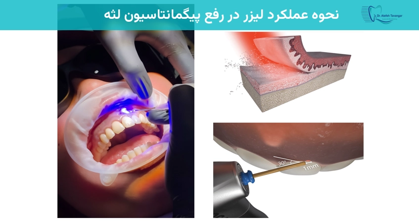 نحوه عملکرد لیزر در رفع پیگمانتاسیون لثه