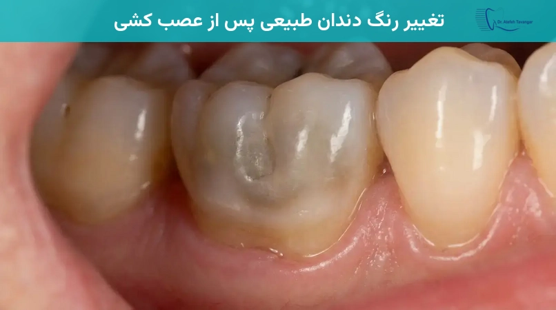 تغییر رنگ دندان طبیعی پس از عصب کشی