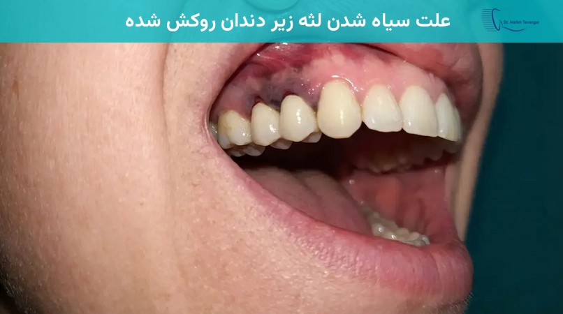 علت سیاه شدن لثه زیر دندان روکش شده