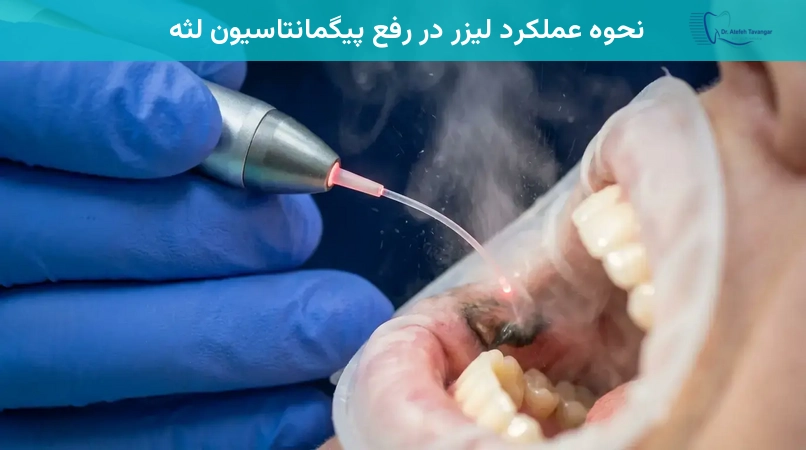 نحوه عملکرد لیزر در رفع پیگمانتاسیون لثه