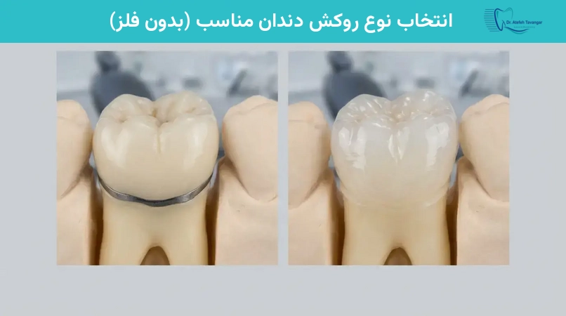 انتخاب نوع روکش دندان مناسب (بدون فلز)