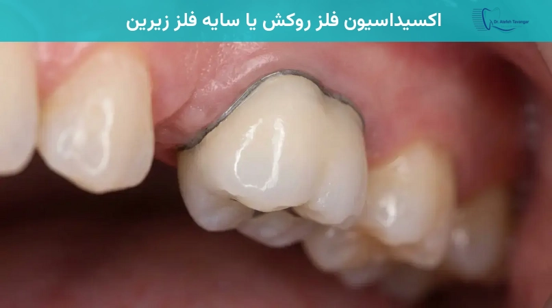 اکسیداسیون فلز روکش یا سایه فلز زیرین