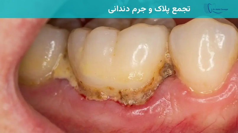 تجمع پلاک و جرم دندانی