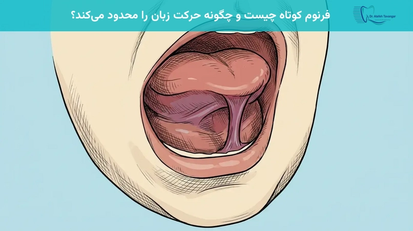 فرنوم کوتاه چیست و چگونه حرکت زبان را محدود میکند؟