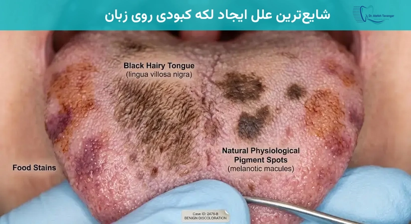 شایعترین علل ایجاد لکه کبودی روی زبان