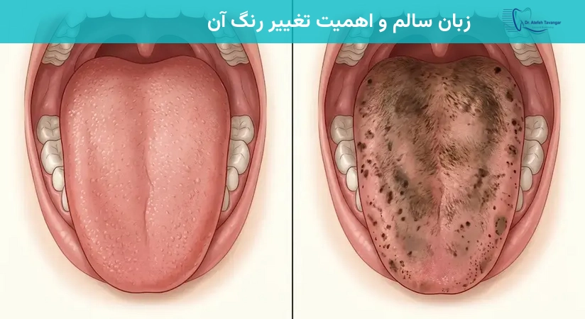 زبان سالم و اهمیت تغییر رنگ آن
