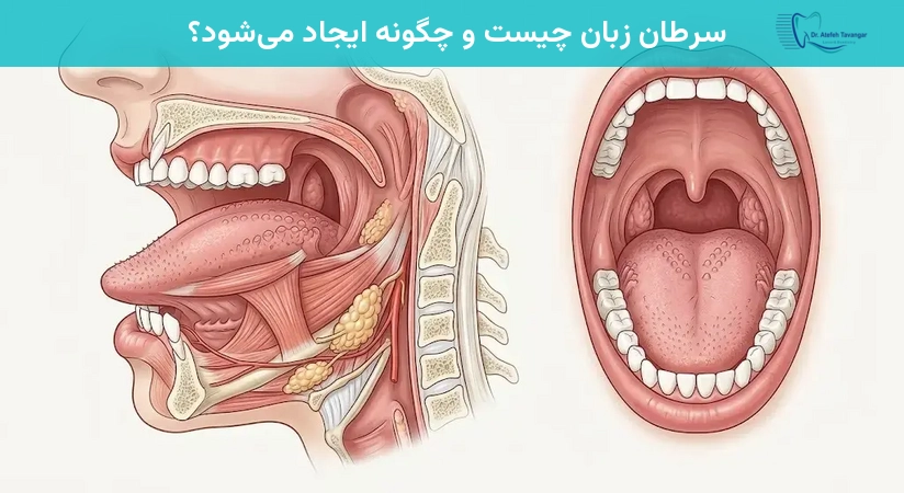 سرطان زبان چیست و چگونه ایجاد میشود؟