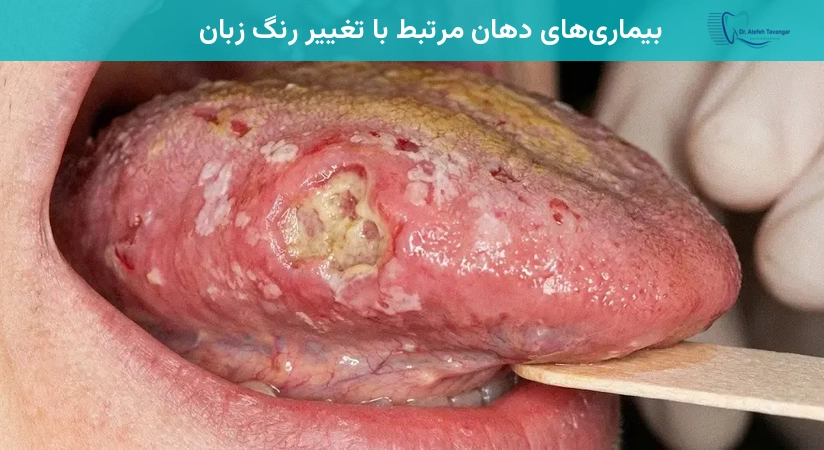 بیماریهای دهان مرتبط با تغییر رنگ زبان