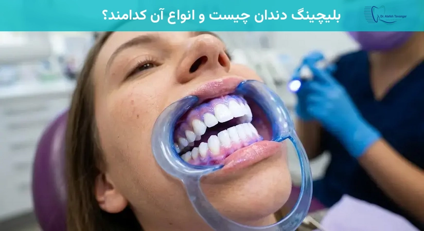 بلیچینگ دندان چیست و انواع آن کدامند؟