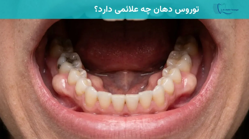 توروس دهان چه علائمی دارد؟