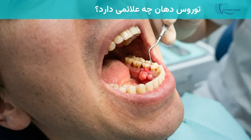 توروس دهان چه زمانی نیاز به درمان دارد؟