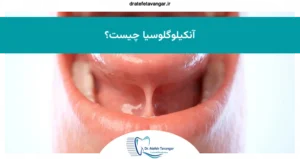 آنکیلوگلوسیا چیست؟