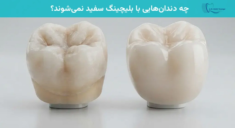چه دندانهایی با بلیچینگ سفید نمیشوند؟