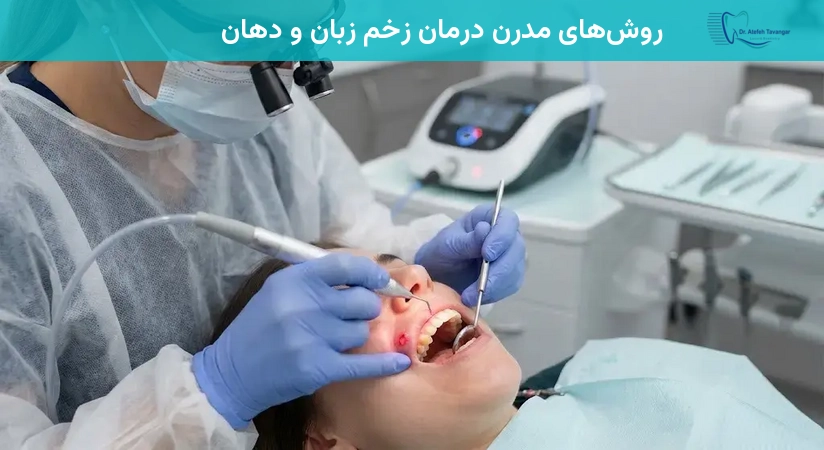 روشهای مدرن درمان زخم زبان و دهان
