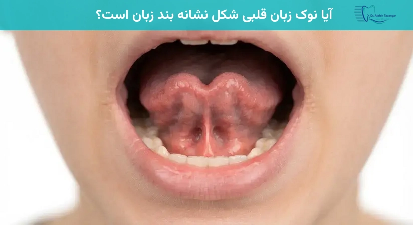 آیا نوک زبان قلبی شکل نشانه بند زبان است؟
