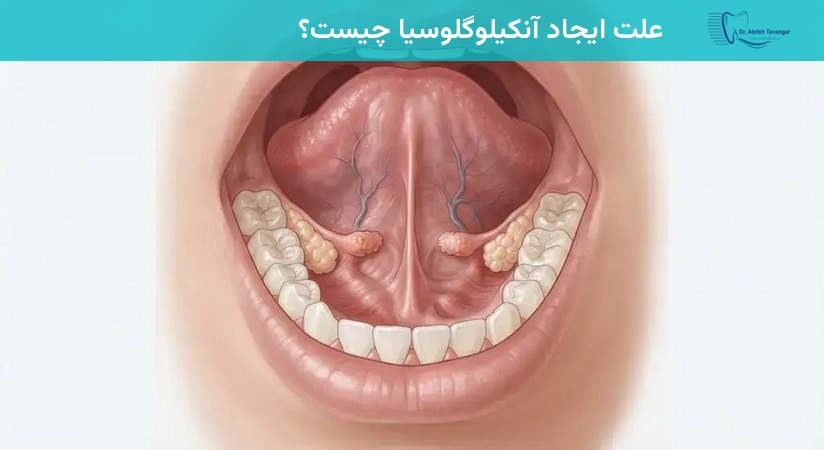 علت ایجاد آنکیلوگلوسیا چیست؟