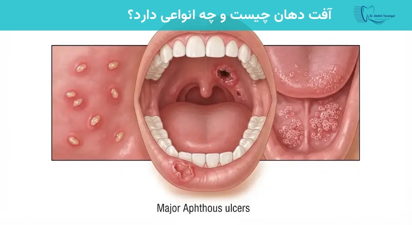 آفت دهان چیست و چه انواعی دارد؟