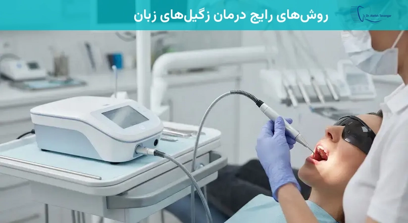 روشهای رایج درمان زگیلهای زبان
