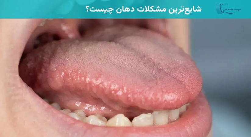 شایعترین مشکلات دهان چیست؟