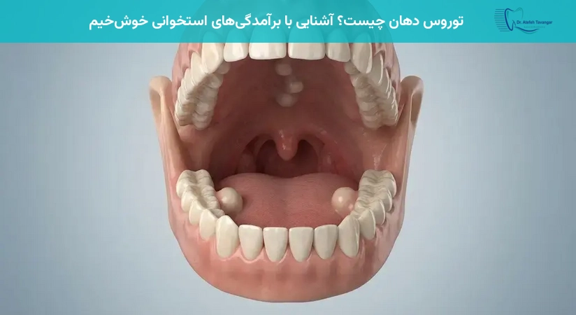 توروس دهان چیست؟ آشنایی با برآمدگیهای استخوانی خوشخیم