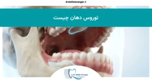 توروس دهان چیست