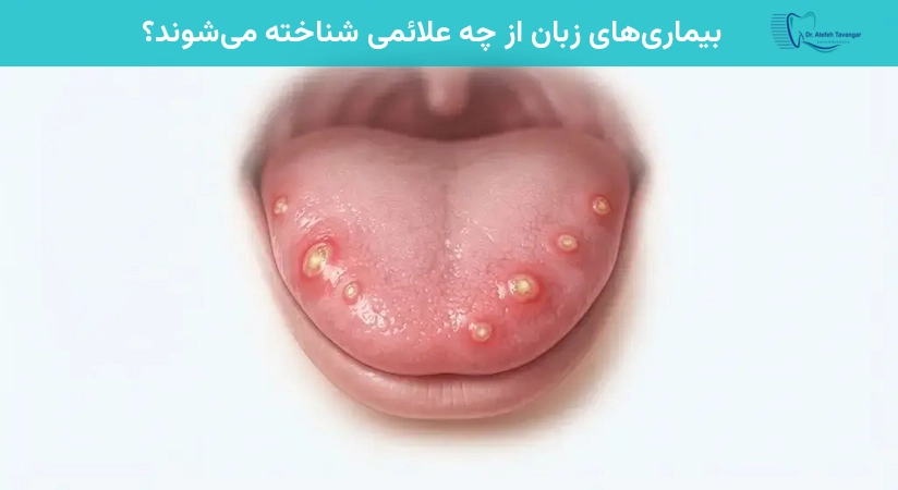 بیماریهای زبان از چه علائمی شناخته میشوند؟