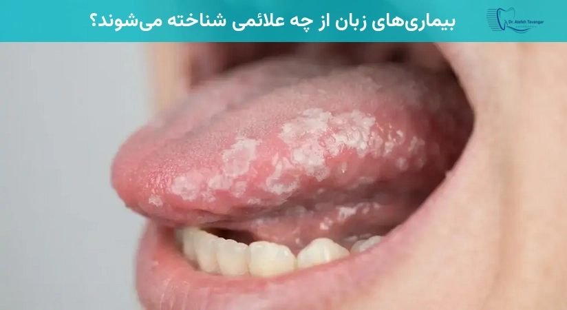 بیماریهای زبان از چه علائمی شناخته میشوند؟