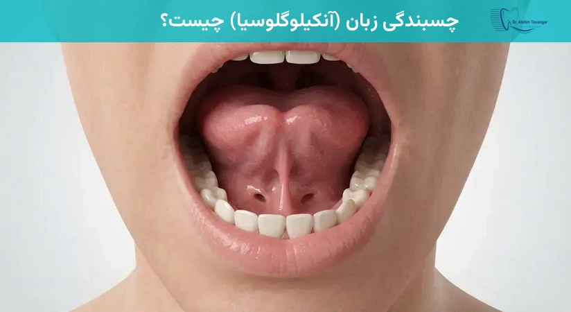 چسبندگی زبان (آنکیلوگلوسیا) چیست؟