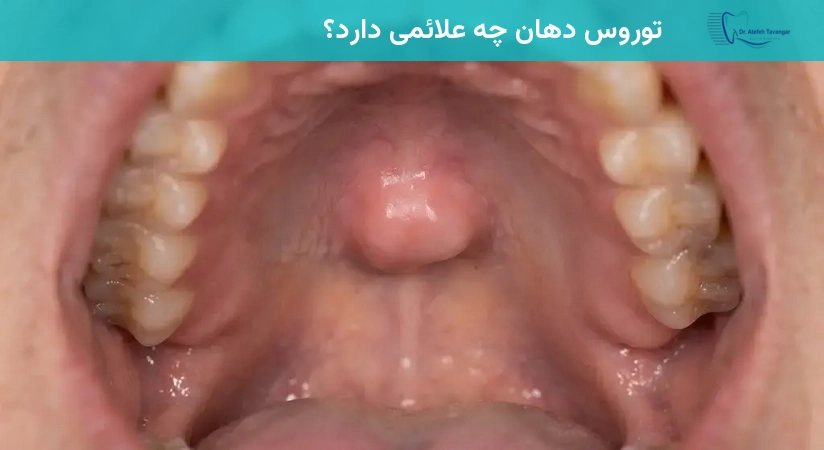 توروس دهان چه علائمی دارد؟